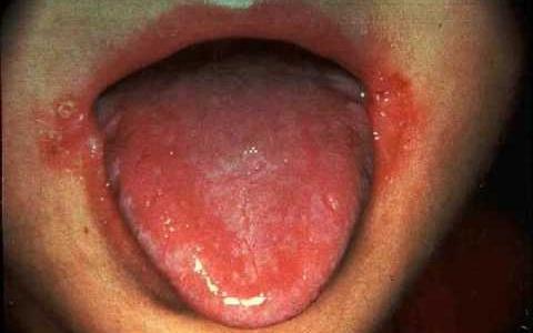 objawy zapalenia jamy ustnej u dzieci zdjęcie