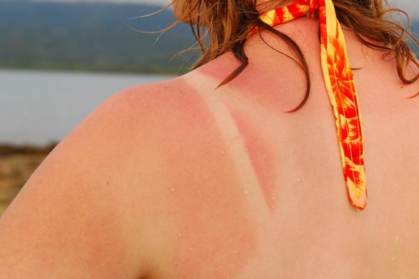 Dostałeś oparzenia słoneczne? Niż do leczenia skóry w takiej sytuacji?